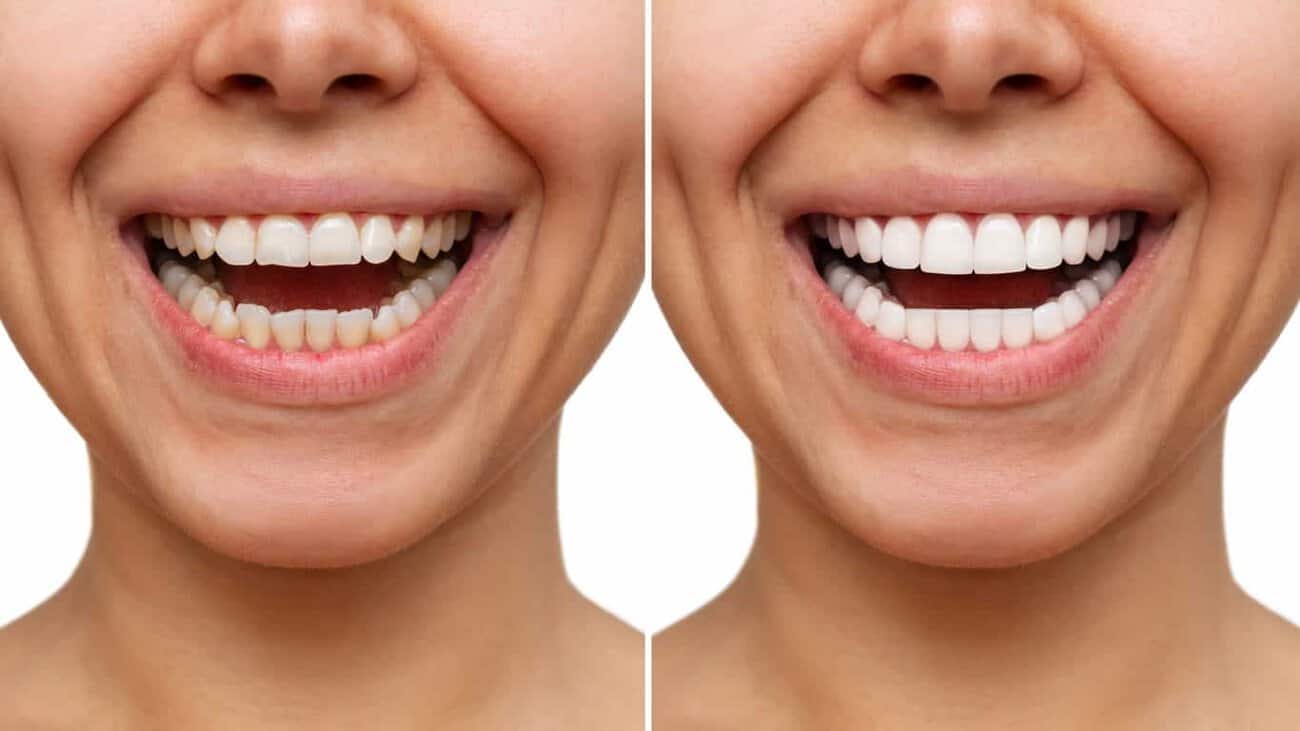 Can Laser Whitening Be Done on Teeth with Fillings or Crown Bognor Regis