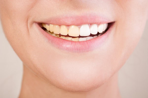 Can Laser Whitening Target Specific Types of Stains Better Than Strips Bognor Regis