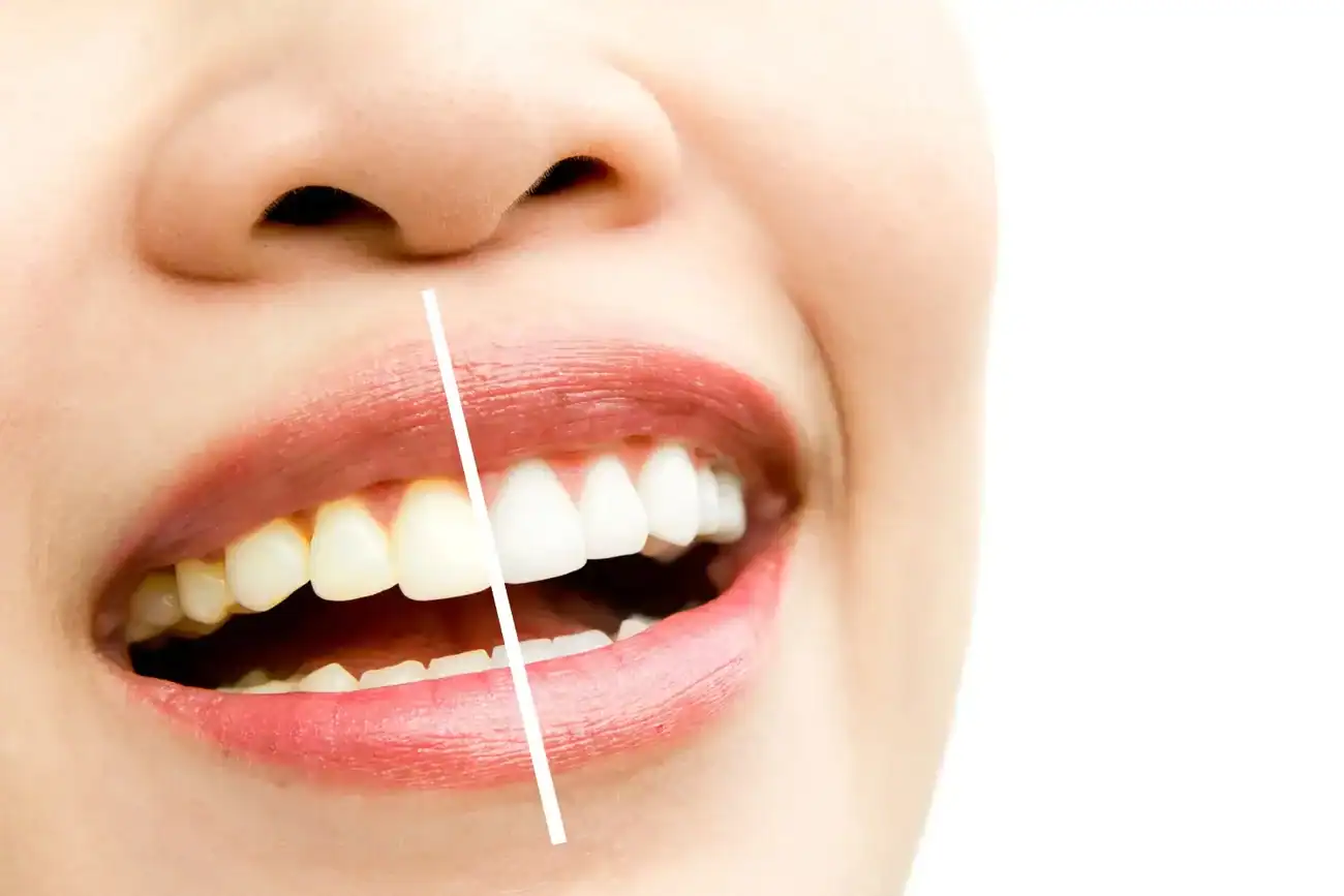 Can Laser Whitening Fix Uneven Tooth Discolouration Bognor Regis