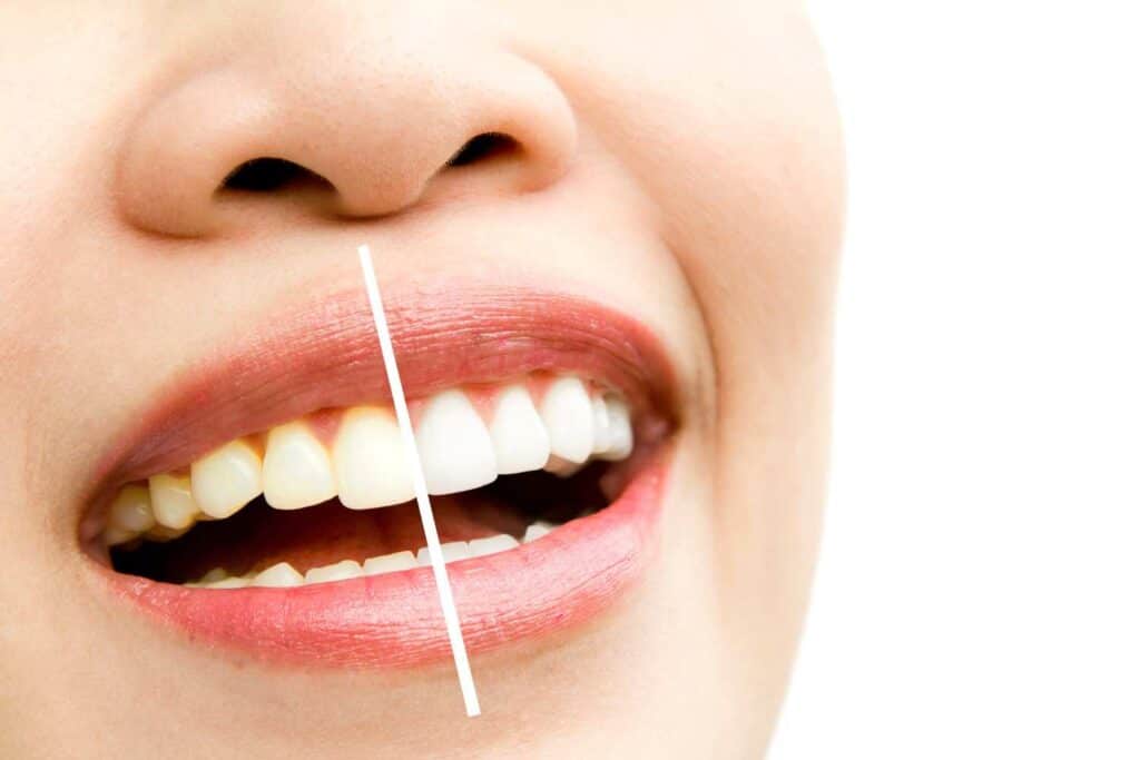 Can I Maintain My New Smile If I&rsquo;m a Coffee or Red Wine Lover Bognor Regis