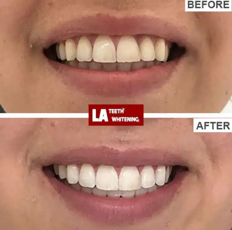 Teeth Whitening Laser Method Bognor Regis Bognor Regis